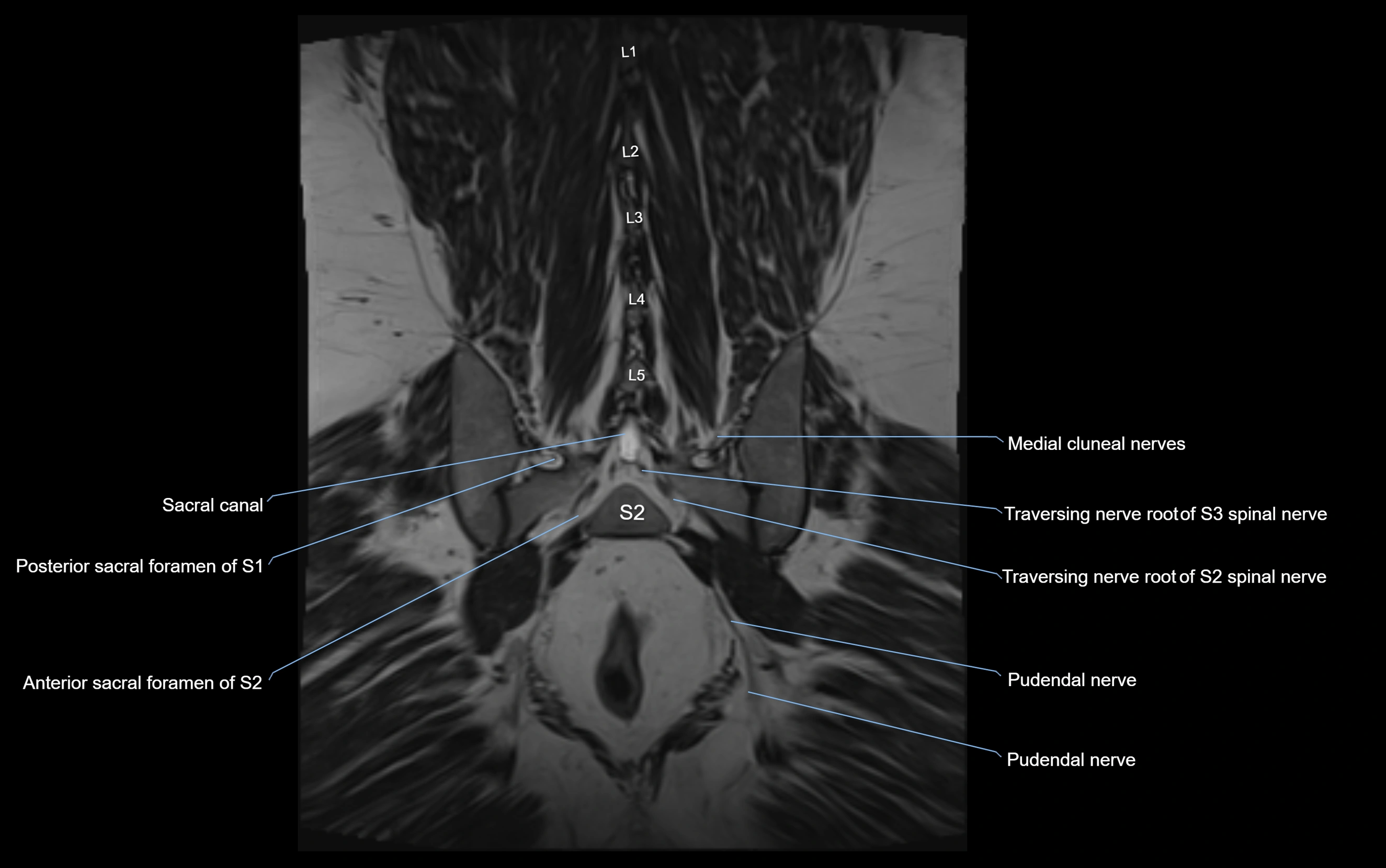 MR lumbosacral plexus cross sectional anatomy 3T  radiology  image-img-09001-00062.webp
